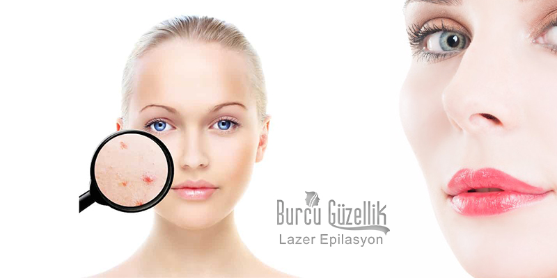 bodrum_lazer_epilasyon